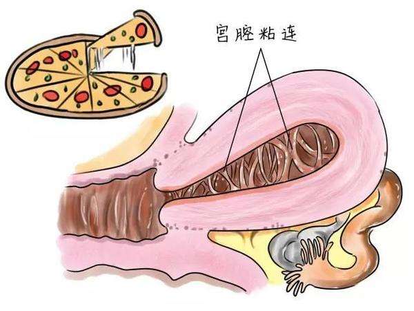 宫腔粘连_宫腔粘连术后怎样防止在次粘连_我的第二次剖宫粘连的肠子掰开