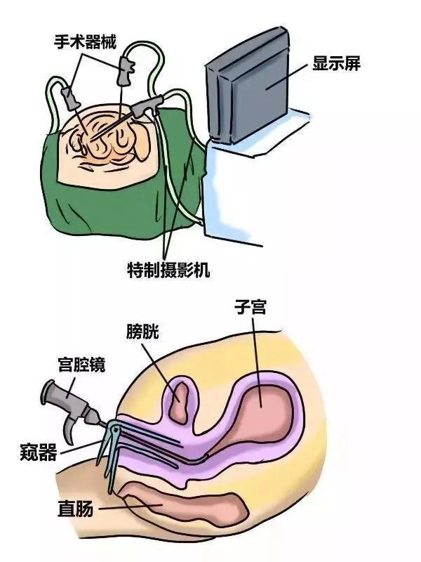 宫腔镜检查后_试管前宫腔镜检查_宫腔镜检查