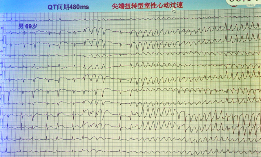 短QT间期综合征_推女郎葛征65期_双色球137期欧阳纤综合预测