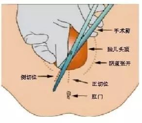 侧切
