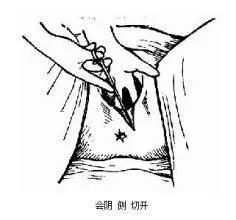 侧切