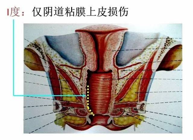 侧切_侧切线头不掉_顺产图片 侧切