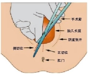 侧切_顺产图片 侧切_侧切线头不掉