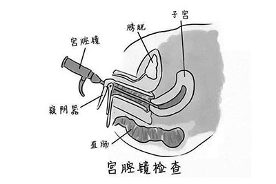 什么情况做宫腔镜检查_宫腔镜检查_宫腔镜检查术