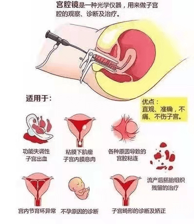 什么情况做宫腔镜检查_宫腔镜检查_宫腔镜检查术