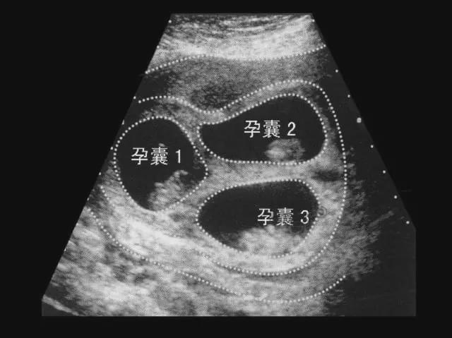 辅助生殖