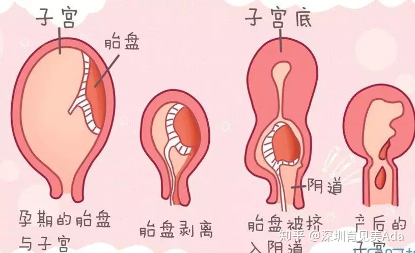 产后恶露