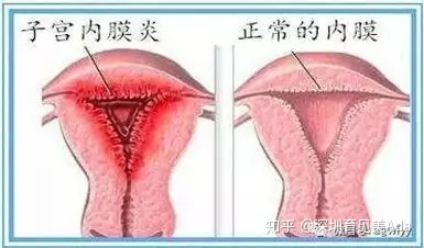 产后恶露