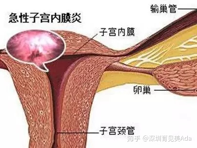 产后恶露