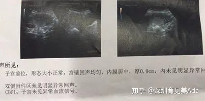 产后恶露