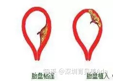 产后恶露