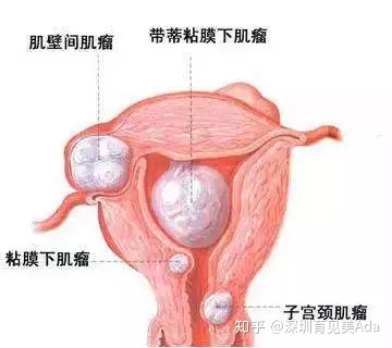 产后恶露
