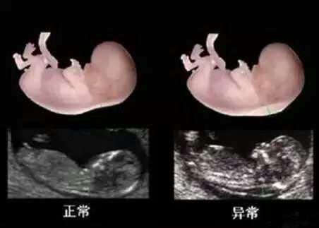 胎儿nt检查_nt检查_胎儿 nt检查