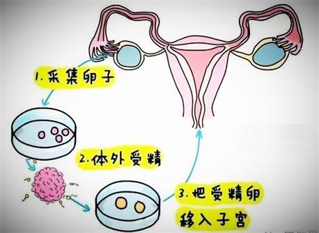 体外受精-胚胎移植