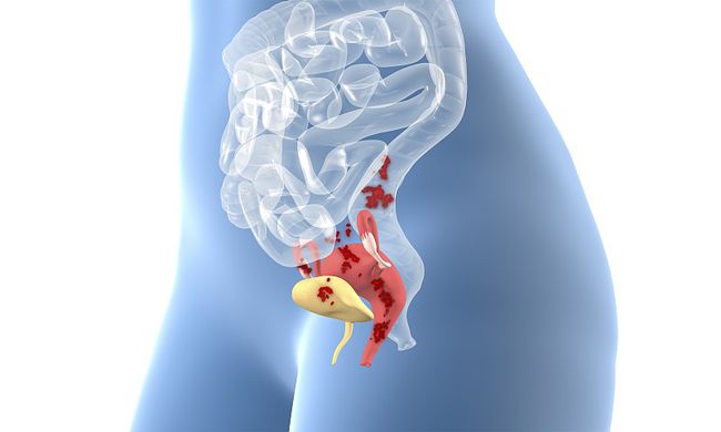 子宫内膜薄_子宫双层内膜厚度多少正常_子宫 内膜 息肉