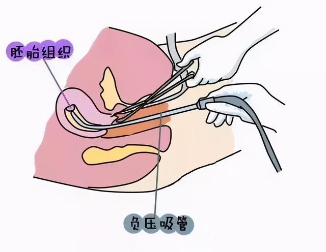 小月子_流产小月子注意事项_小月子吃什么好