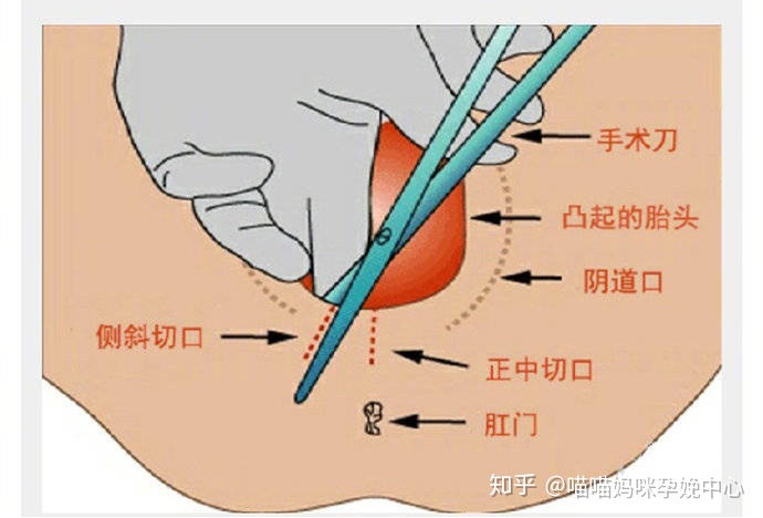 侧切