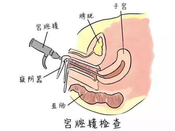宫腔环境检查