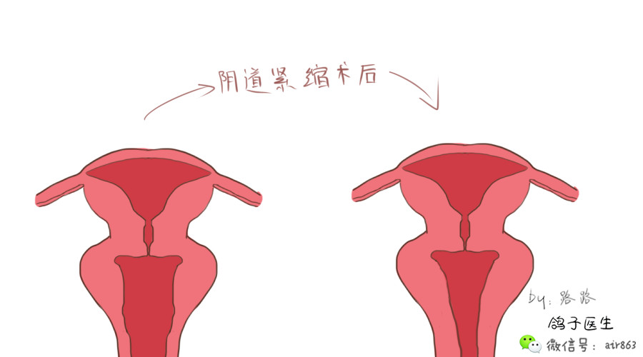 盆底肌修复_盆底肌康复治疗仪_盆底肌康复治疗