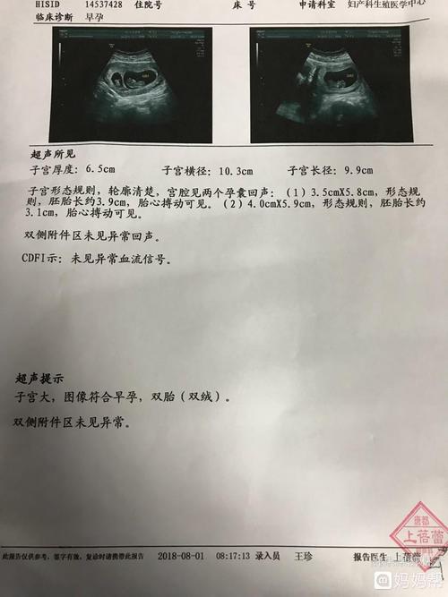 多胎妊娠_足月妊娠胎心率_单胎妊娠是什么意思