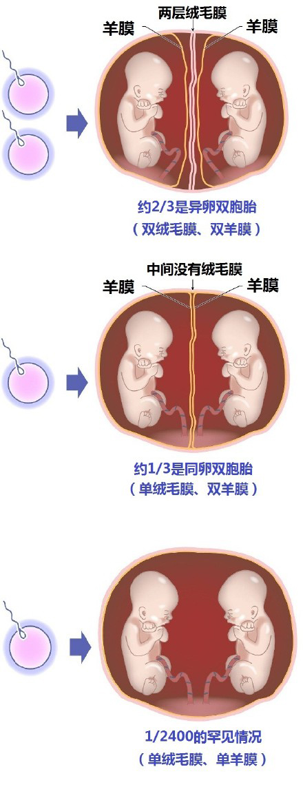 单胎妊娠是什么意思_多胎妊娠_足月妊娠胎心率