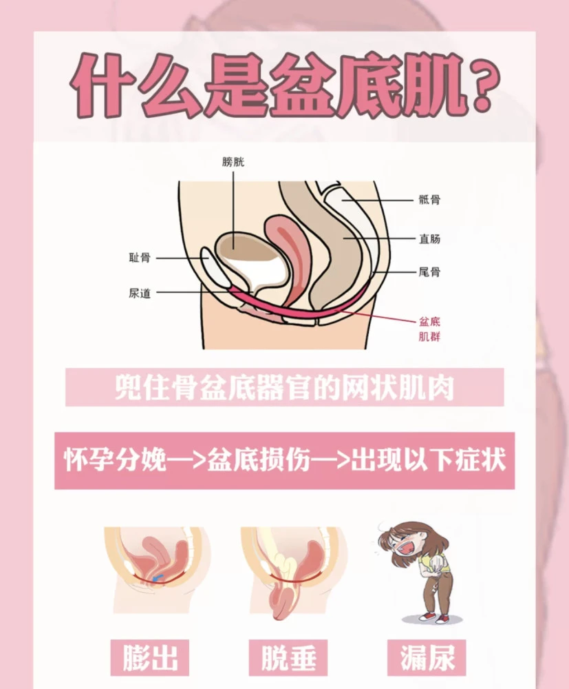 盆底肌修复