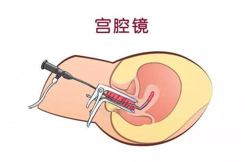 宫腔环境检查