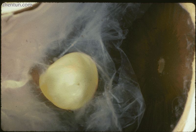 马凡综合征