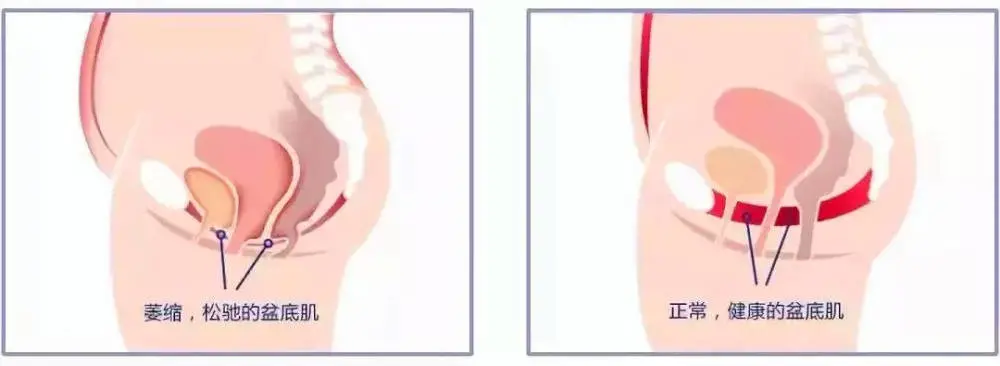 盆底肌修复