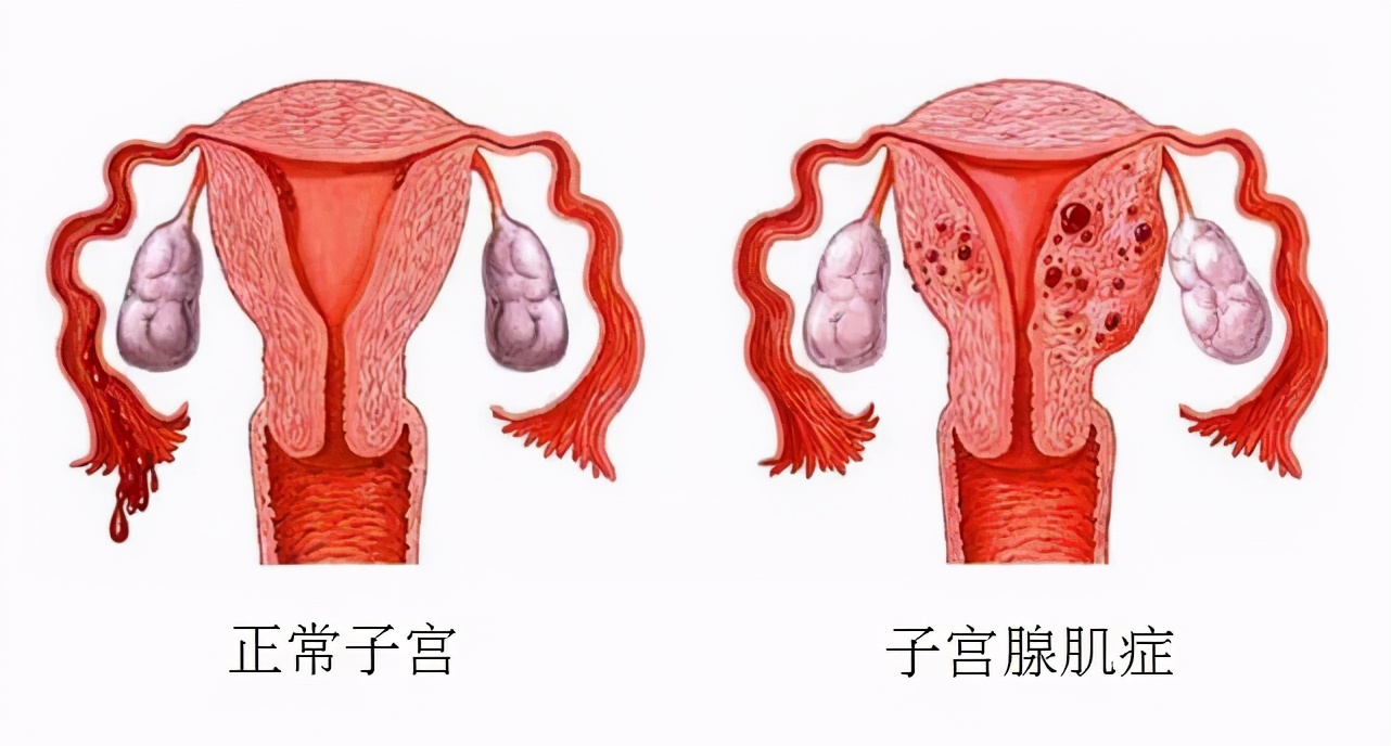 痛过生娃！“不死的癌症”：子宫腺肌症