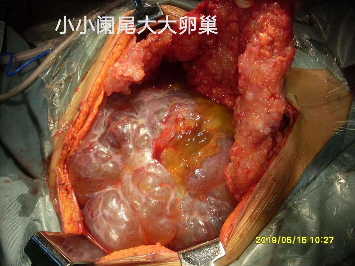 皮样囊肿或皮脂腺囊肿图片_巧克力囊肿_双肾多发囊肿左侧伴钙囊肿