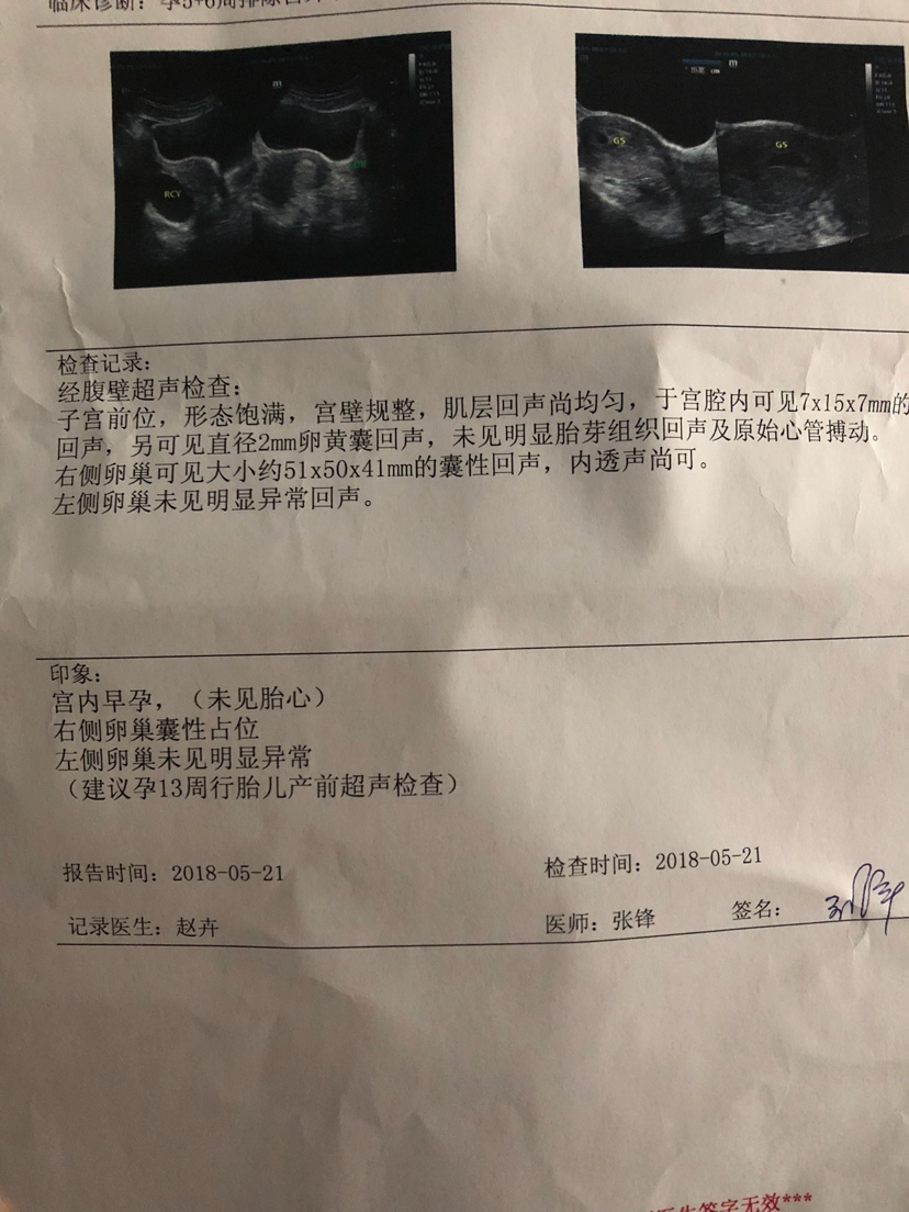 巧克力囊肿_皮样囊肿或皮脂腺囊肿图片_双肾多发囊肿左侧伴钙囊肿