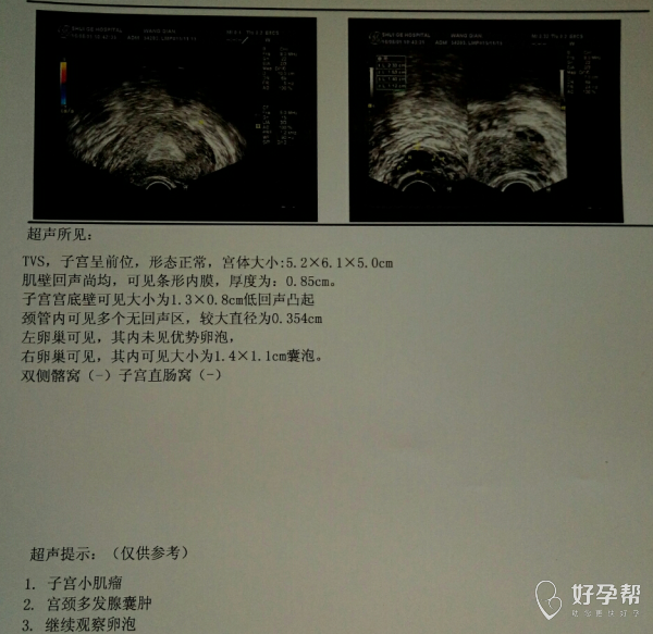 皮样囊肿或皮脂腺囊肿图片_双肾多发囊肿左侧伴钙囊肿_巧克力囊肿