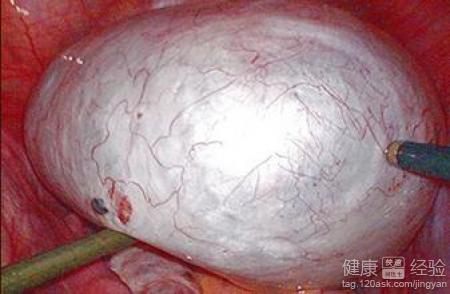 巧克力囊肿_好丽友q蒂摩卡 巧克力味 榛子巧克力_双肾多发囊肿左侧伴钙囊肿