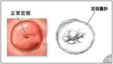 巧克力囊肿_好丽友q蒂摩卡 巧克力味 榛子巧克力_双肾多发囊肿左侧伴钙囊肿