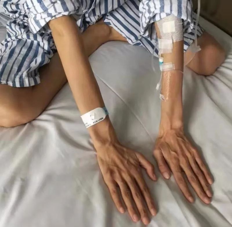 马凡氏综合症