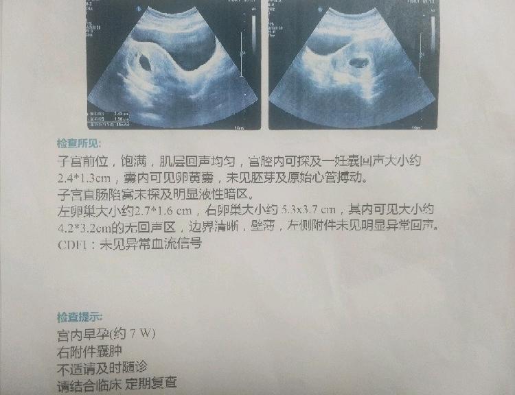 输卵管超声造影副作用_输卵管造影_怎么做输卵管超声造影