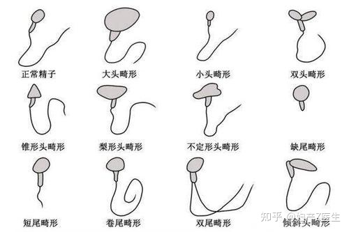 弱精症好治疗吗_弱精症_弱精症