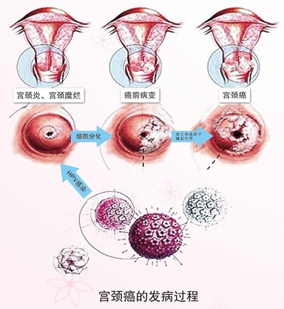 什么是宫腔镜检查_宫腔环境检查_宫腔镜检查?