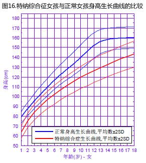 特纳氏综合症_特纳氏综合症 病因_特纳氏综合症男性