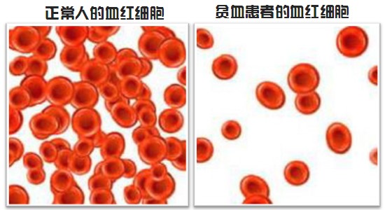 地中海贫血_地海中贫血图片_地海中贫血是什么病