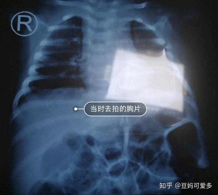 新生儿吐奶