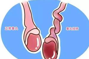 睾丸扭转坏死_睾丸扭转_睾丸扭转病理