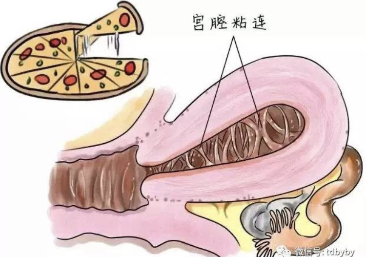宫腔粘连