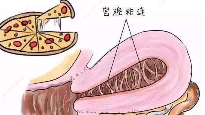 宫腔粘连