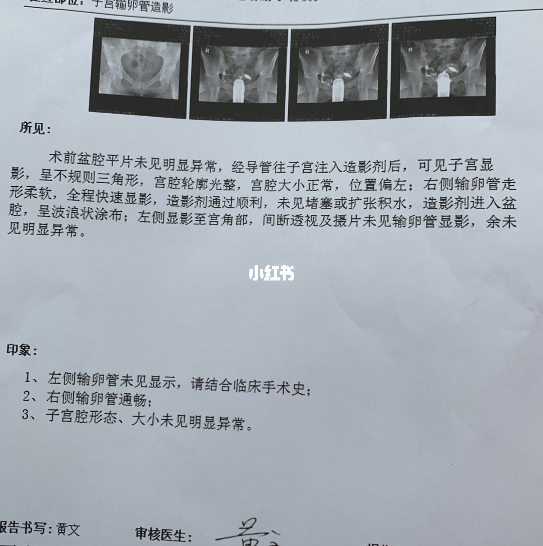 输卵管b超造影和x造影_输卵管超声造影疼不疼_输卵管造影