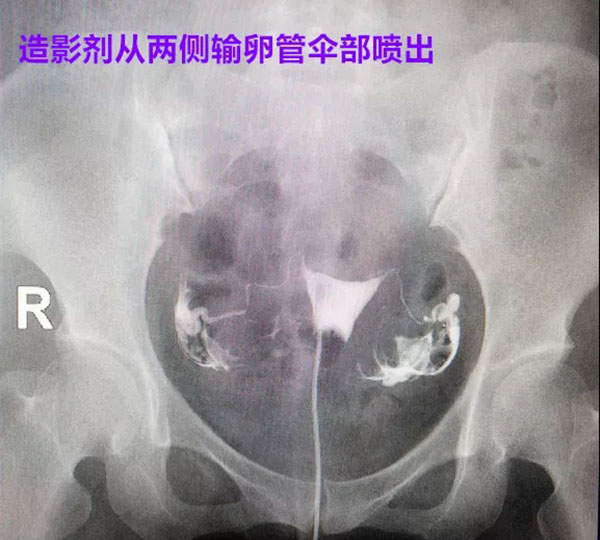 输卵管造影_造影有疏通输卵管吗_怎么做输卵管超声造影