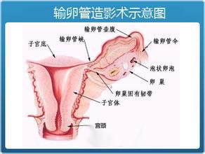 怎么做输卵管超声造影_造影有疏通输卵管吗_输卵管造影