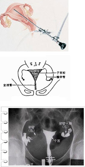 造影有疏通输卵管吗_怎么做输卵管超声造影_输卵管造影