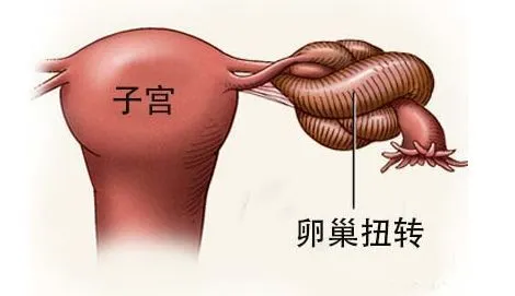 囊肿巧克力 囊肿_脚踝 囊肿 微波理疗仪 治疗囊肿_巧克力囊肿